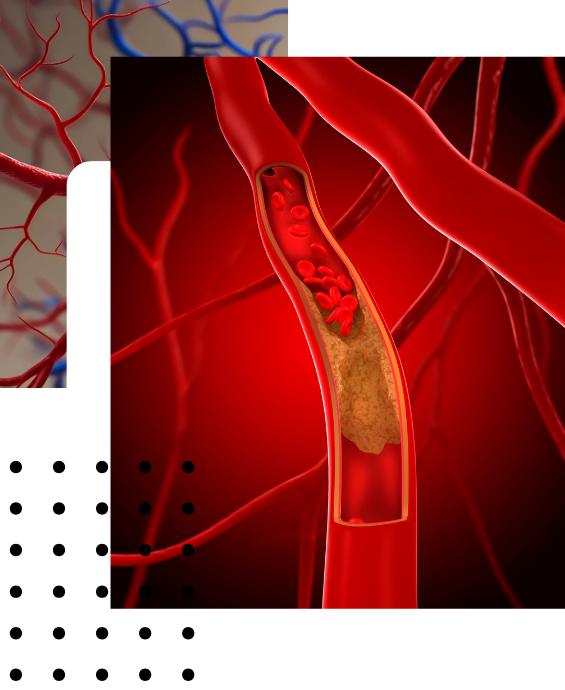 about-atherosclerosis