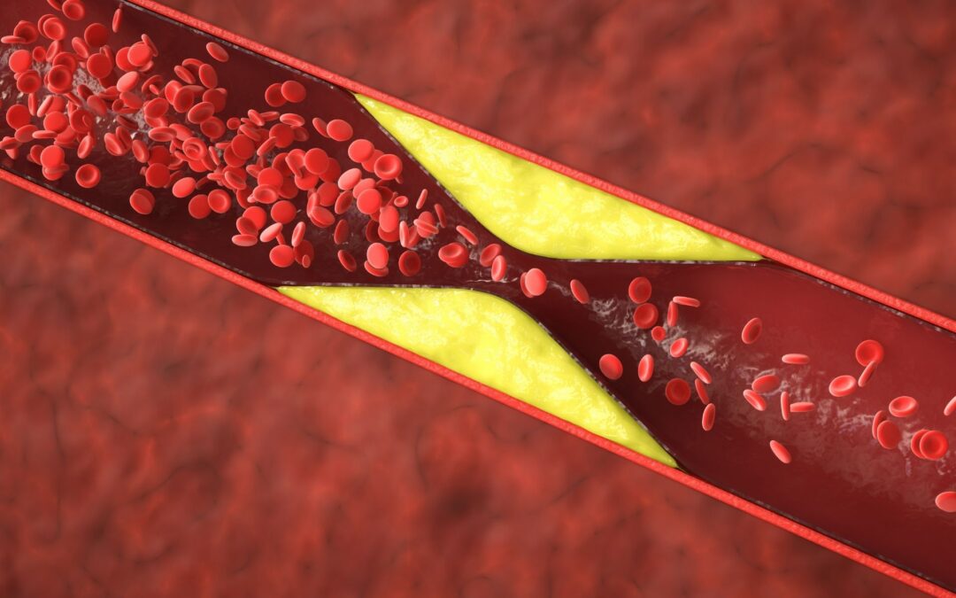 Can Atherosclerosis Be Reversed Naturally?