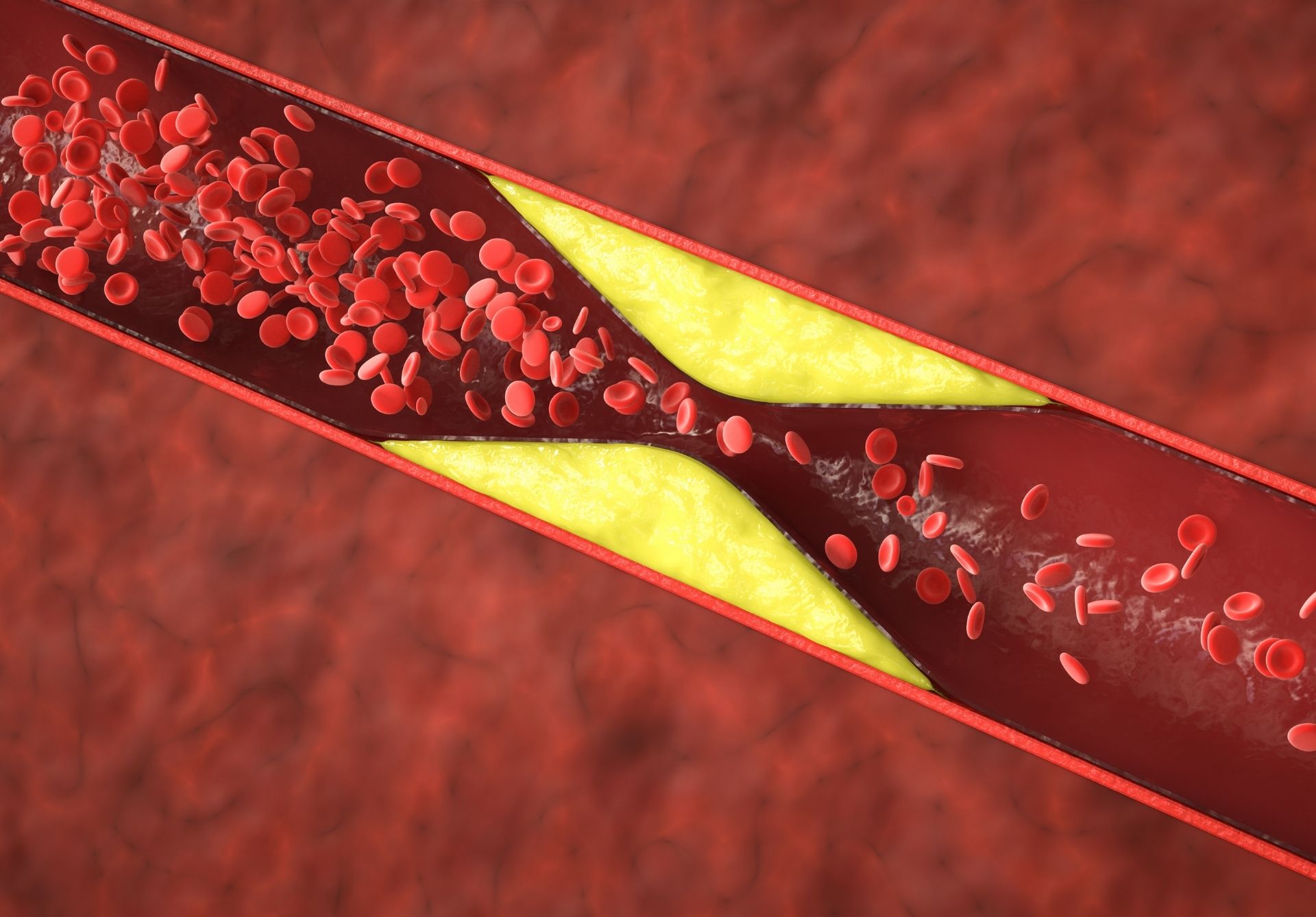 blog-Can-Atherosclerosis-Be-Reversed-Naturally