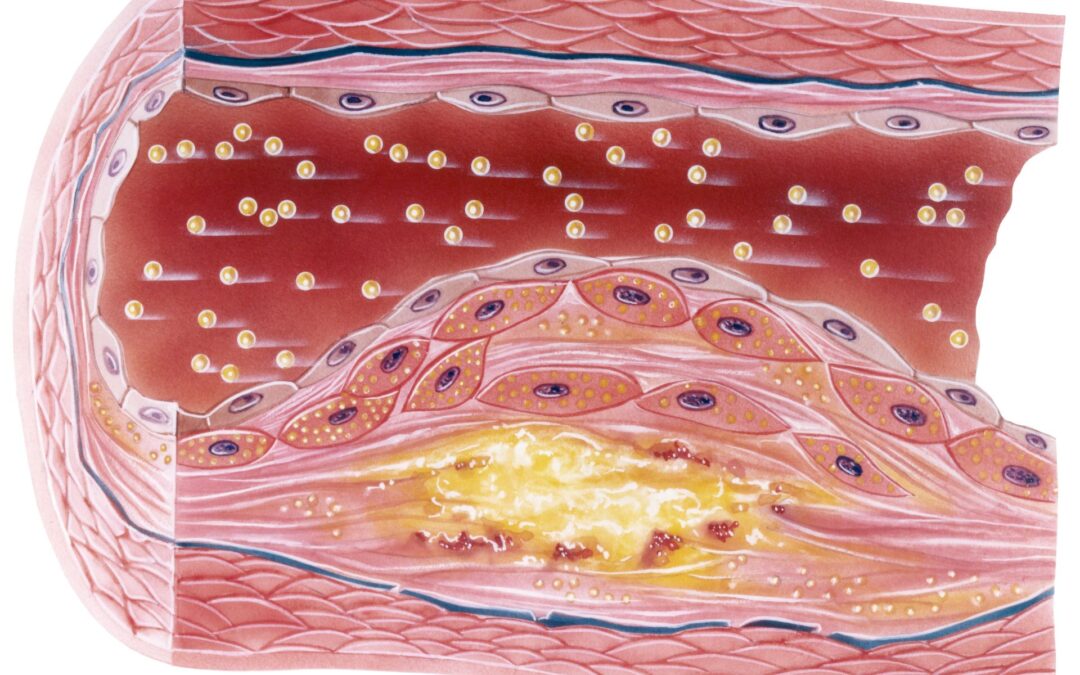 What Causes Plaque To Build Up In The Arteries?