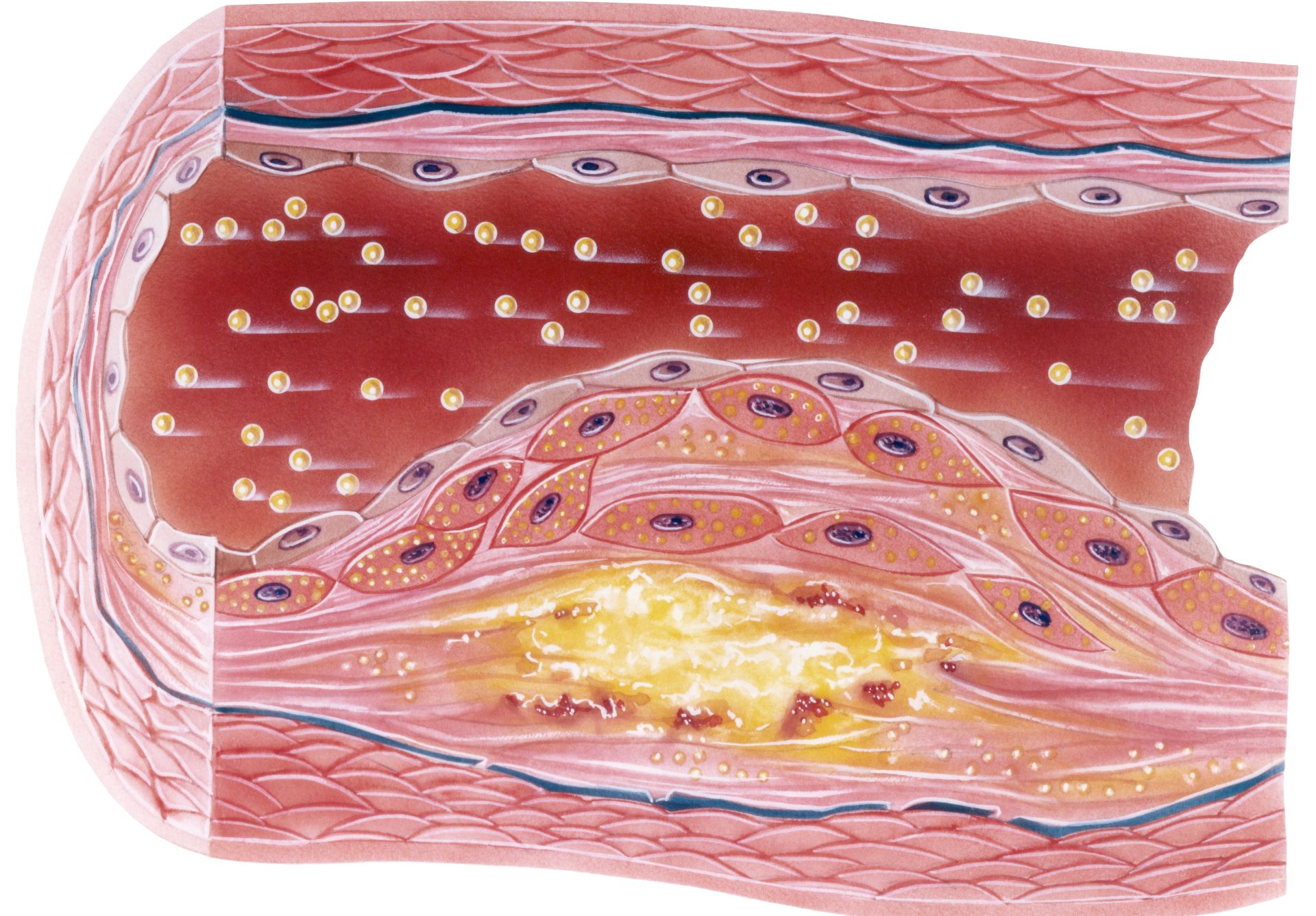 blog-What-Causes-Plaque-To-Build-Up-In-The-Arteries